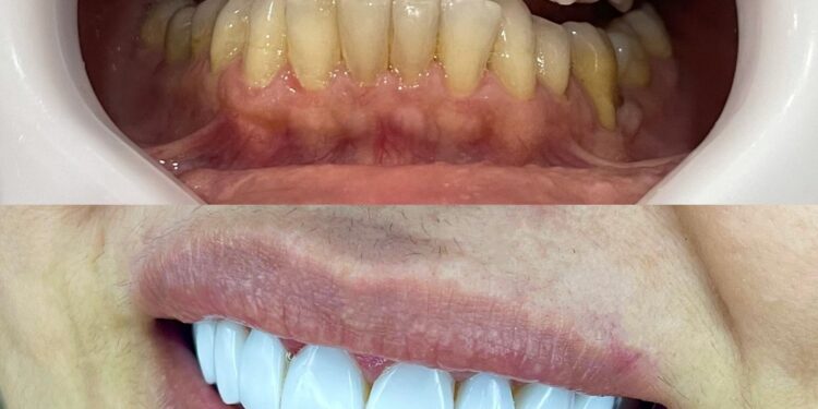 Setor de implantes dentários cresce na pandemia