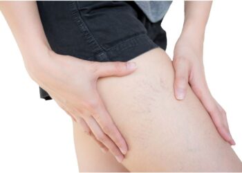 Varizes estão entre as doenças vasculares mais comuns e afetam cerca de 60% dos adultos 