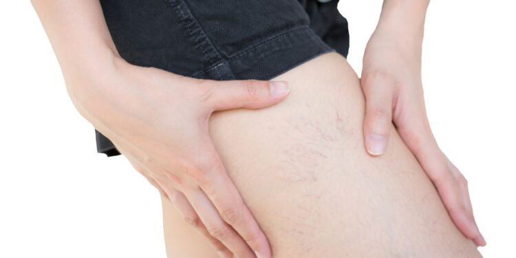 Varizes estão entre as doenças vasculares mais comuns e afetam cerca de 60% dos adultos 